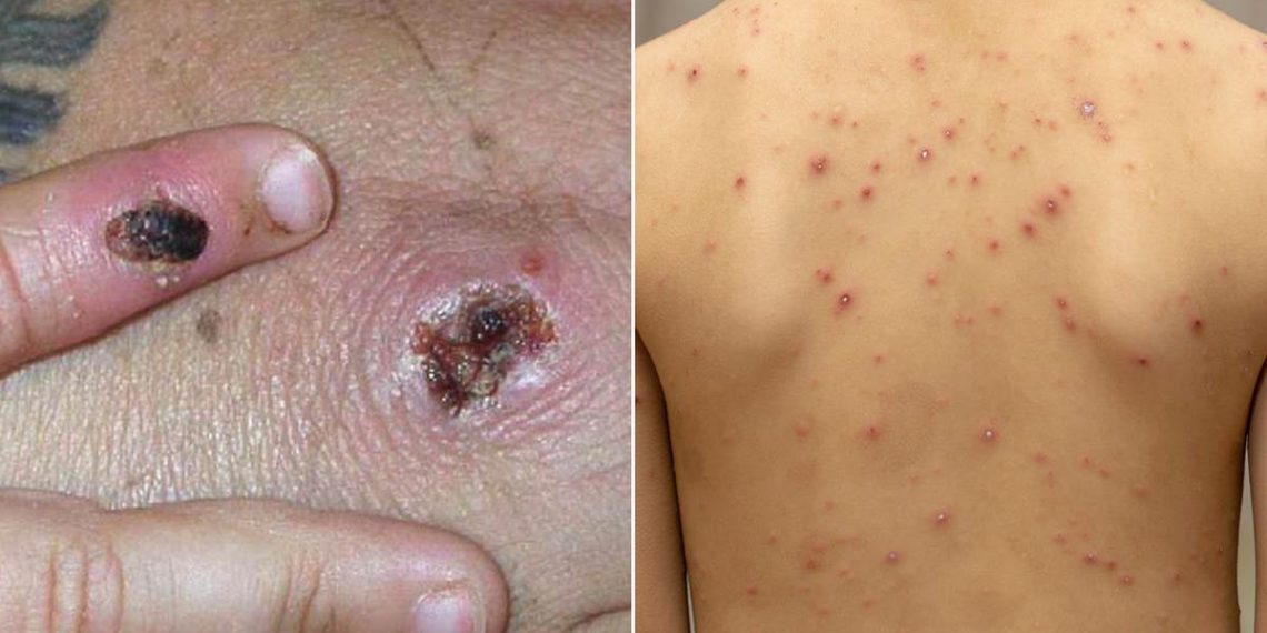 What is the difference between monkeypox and chickenpox - Travel News, Insights & Resources.