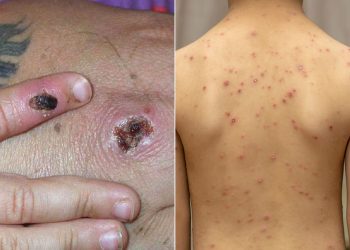 What is the difference between monkeypox and chickenpox - Travel News, Insights & Resources.