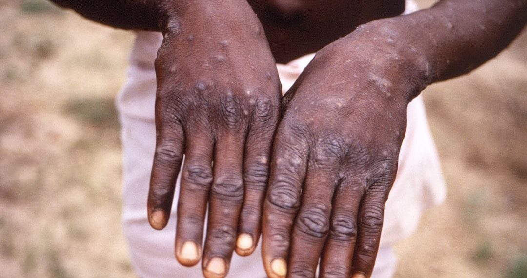A2 lineage of Monkeypox is mutating slow and sharp alert - Travel News, Insights & Resources.