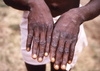 Analysis Pandemic fatigue stigma may drive monkeypox spread in Malaysia - Travel News, Insights & Resources.