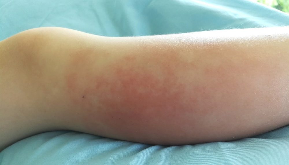 Cellulitis a deep bacterial infection of the skin as a - Travel News, Insights & Resources.