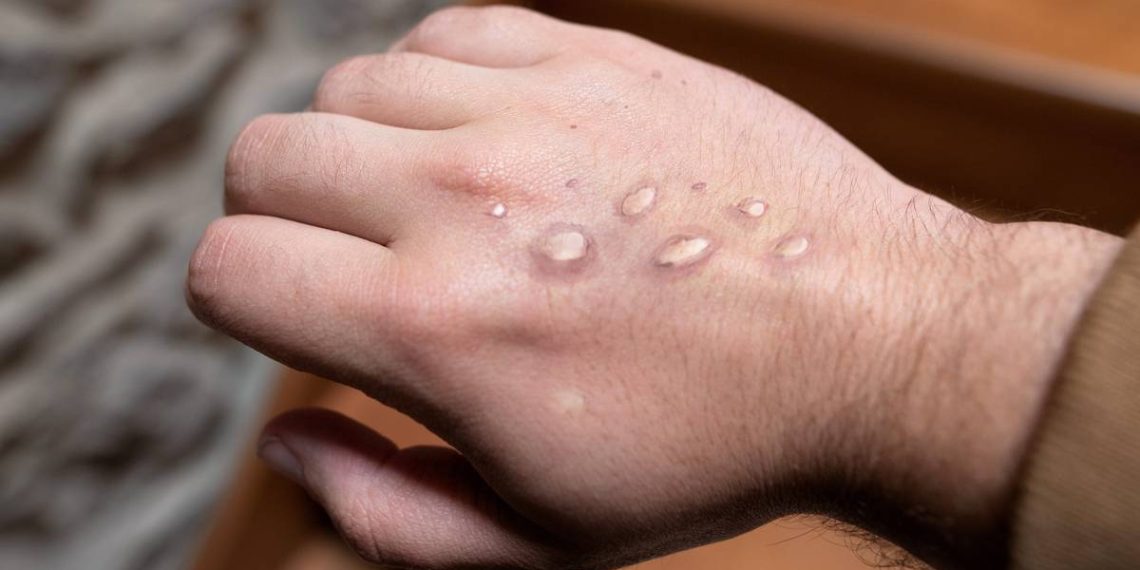 Four new cases of monkeypox in New Zealand - Travel News, Insights & Resources.