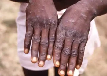 Monkeypox Sixth case reported in Delhi patient in stable condition - Travel News, Insights & Resources.