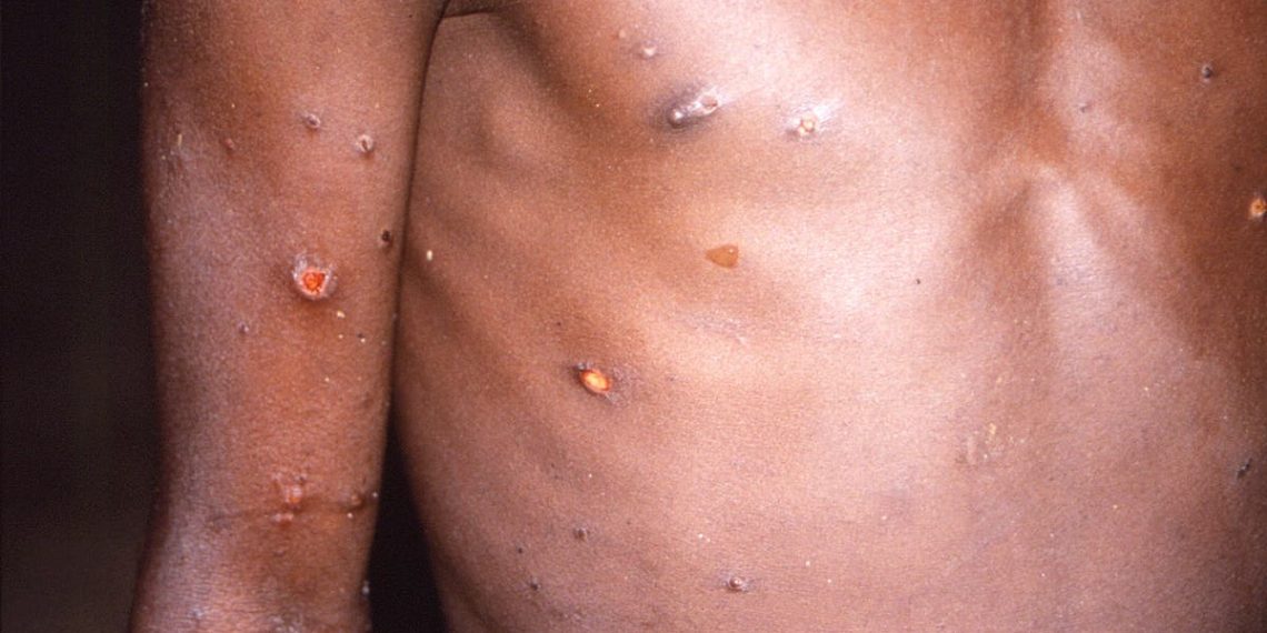 Second monkeypox strain linked with travel to West Africa identified - Travel News, Insights & Resources.