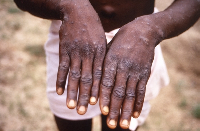 ‘Persons who had contact with 4th monkeypox case show no - Travel News, Insights & Resources.
