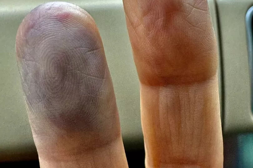 Two bruised and purple fingers